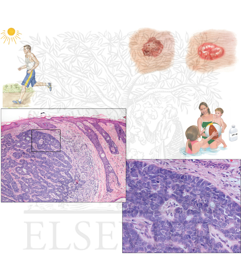 Pathology of Integumentary System