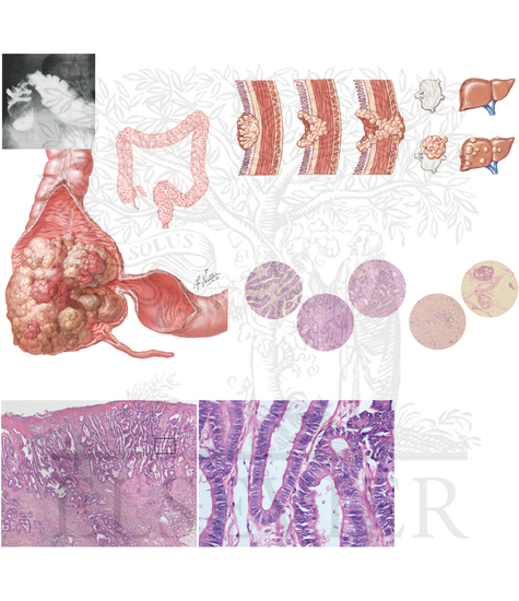 Pathology of Lower Digestive System