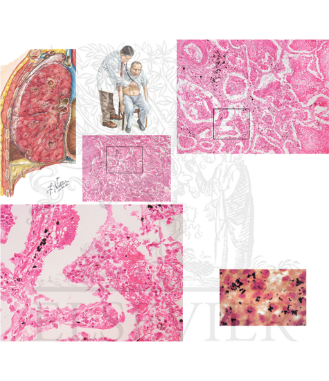 Pathology of Respiratory System