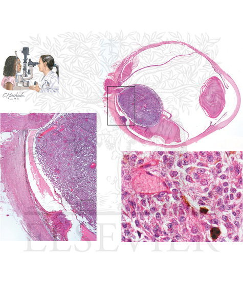 Pathology of Eye and Adnexa