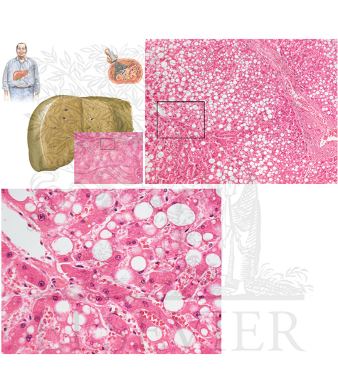 Pathology of Liver