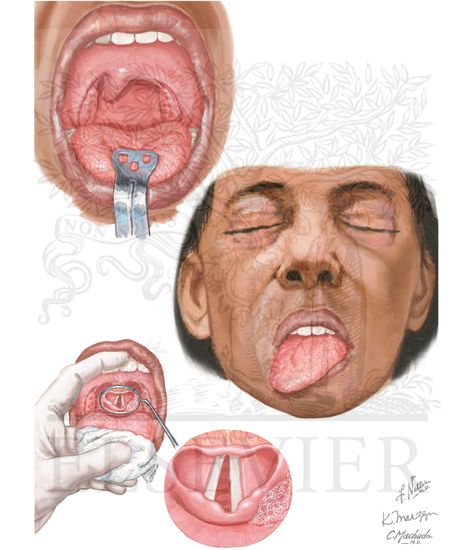 NEUROGENIC DISORDERS OF MOUTH AND PHARYNX (X AND XII)