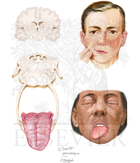 DISORDERS OF HYPOGLOSSAL NUCLEUS AND NERVE