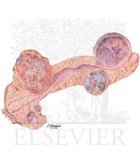 Cystic Tumors