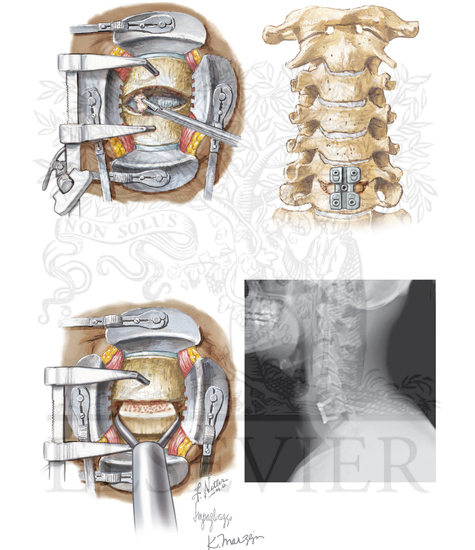 Watermarked preview of unlabeled image: Anterior Cervical Spine Decompression and Stabilization
