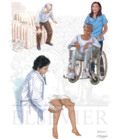 Diabetic Lumbosacral
Radiculoplexus Neuropathy