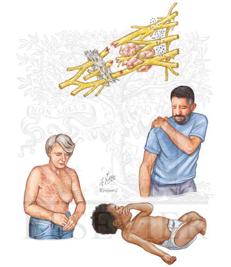 BRACHIAL PLEXOPATHY