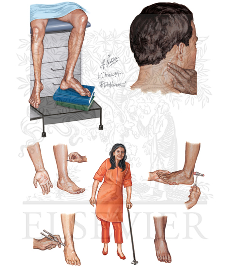 Charcot-Marie-Tooth Disease
Overview (Hereditary Motor
and Sensory Neuropathy)