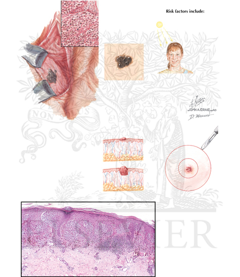 Melanoma: Mucocutaneous Malignant Melanoma