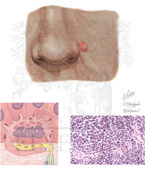 Merkel Cell Carcinoma