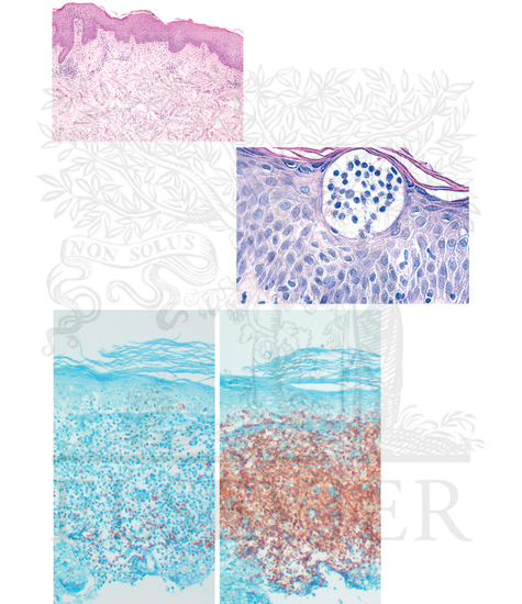 Mycosis Fungoides: Histologic Analysis of Cutaneous T-Cell Lymphoma