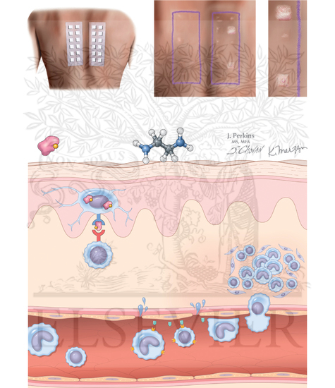 Allergic Contact Dermatitis: Patch Testing and Type IV Hypersensitivity