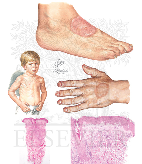 Granuloma Annulare