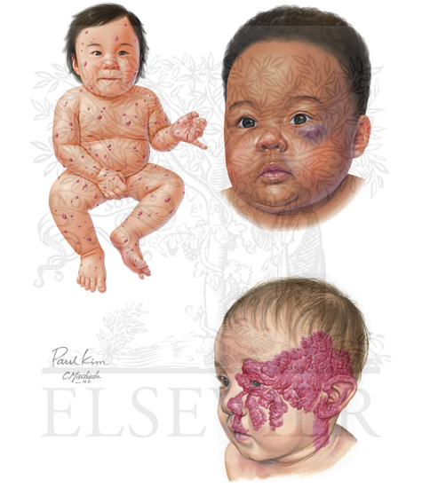 Infantile Hemangiomas