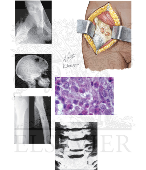 Langerhans Cell Histiocytosis: Eosinophilic Granuloma