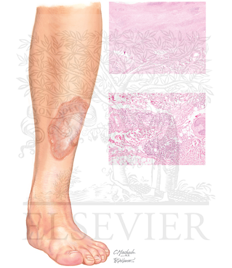 Necrobiosis Lipoidica