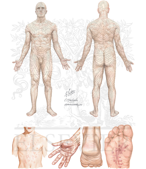 Pityriasis Rosea