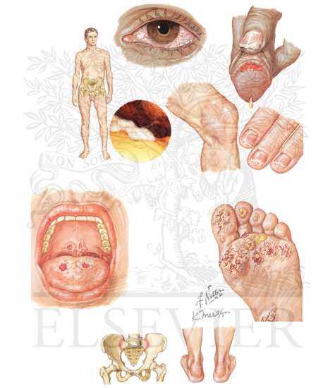 Reactive Arthritis (Reiter Syndrome)