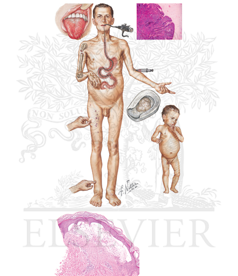 Dermatitis Herpetiformis