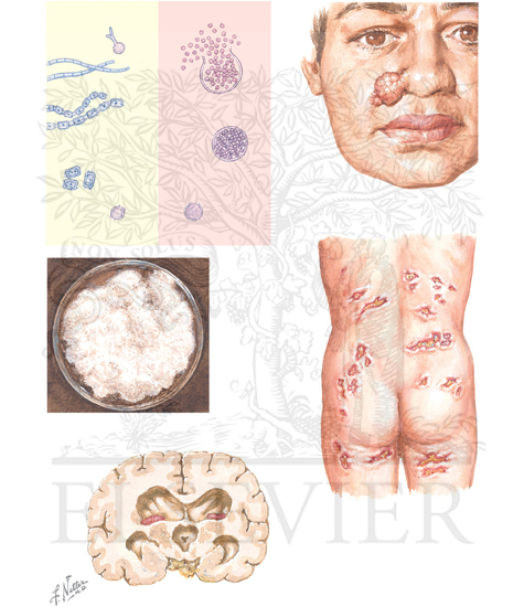 Watermarked preview of unlabeled image: Coccidioidomycosis