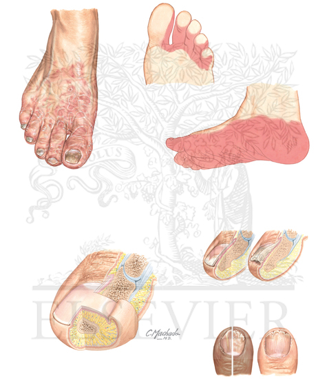 Watermarked preview of unlabeled image: Dermatophytoses: Tinea Pedis and Tinea Unguium