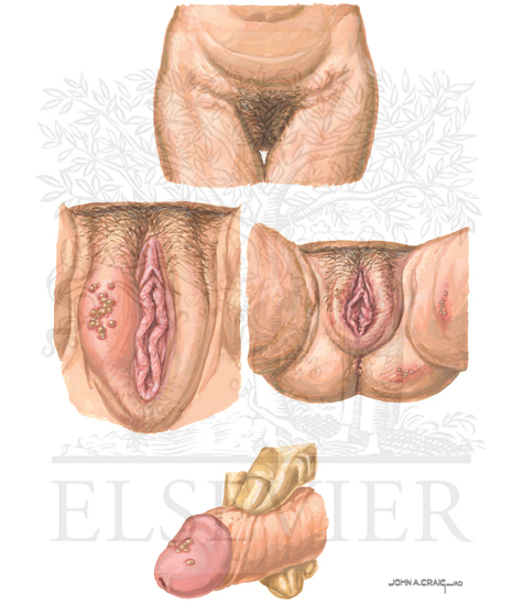 Herpes Simplex Virus: Lesions