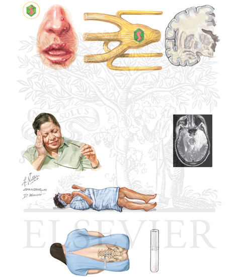 Herpes Simplex Virus: Encephalitis