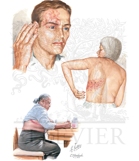 Herpes Zoster (Shingles): Clinical Presentation