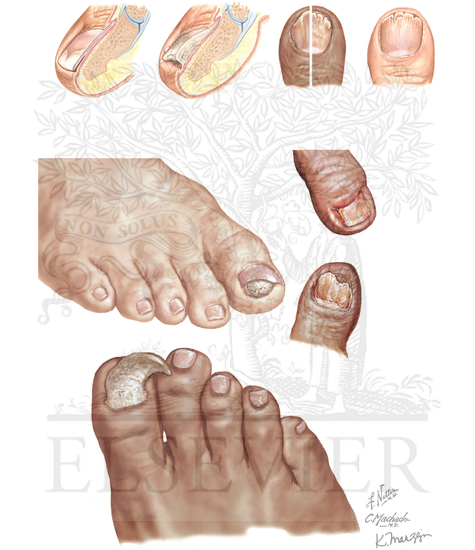 Common Nail Disorders: Toenail Disorders