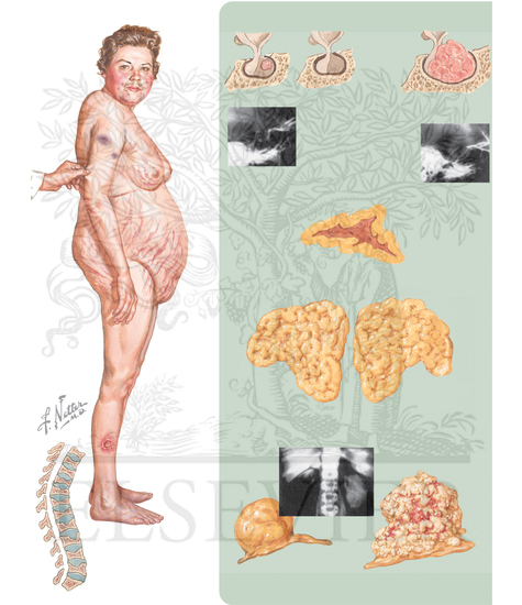 Cushing Syndrome and Cushing Disease