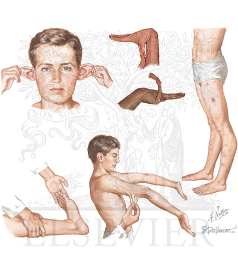 Ehlers-Danlos Syndrome