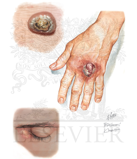 Muir-Torre Syndrome