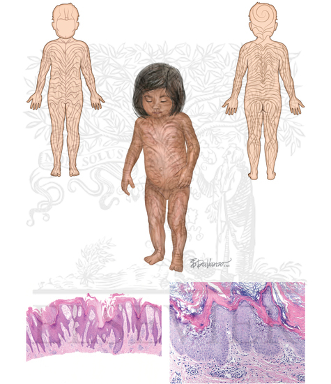 Epidermal Nevus
