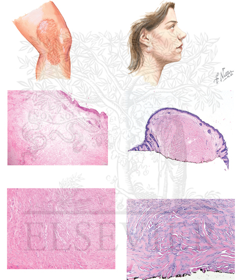 Watermarked preview of unlabeled image: Keloid and Hypertrophic Scar