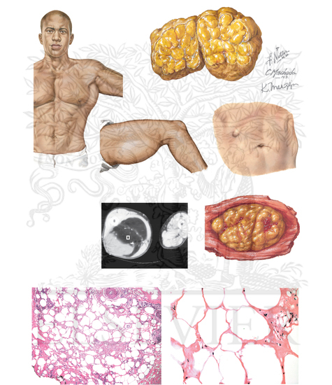 Lipoma