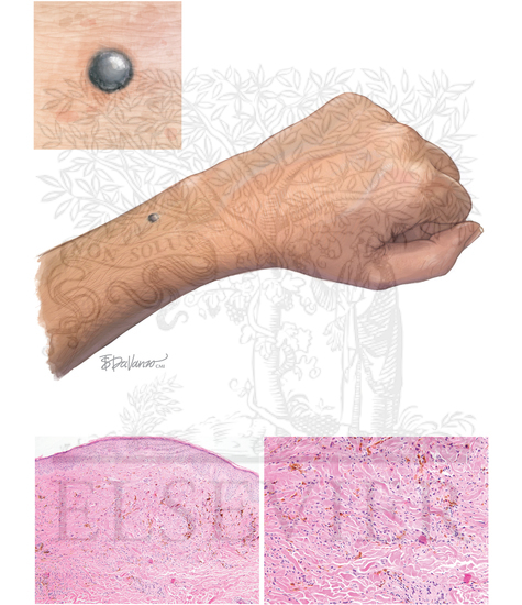Melanocytic Nevi: Blue Nevi