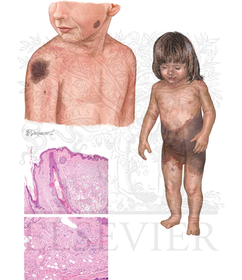 Melanocytic Nevi: Congenital Nevi