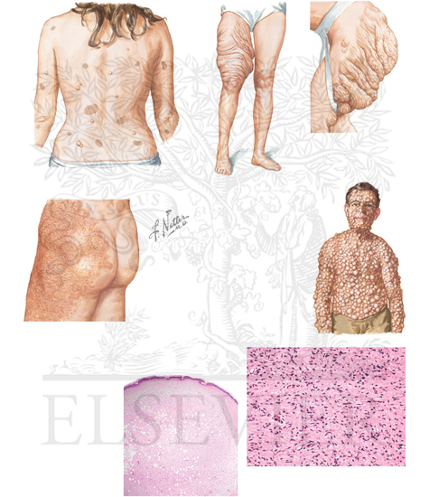 Neurofibroma