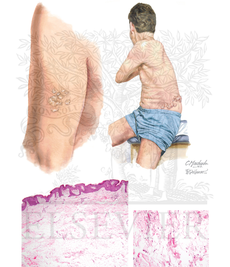 Nevus Lipomatosus Superficialis