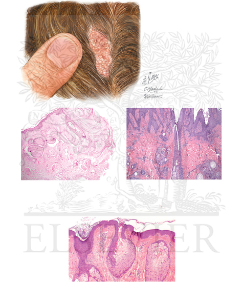 Nevus Sebaceous