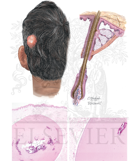 Pilar Cyst (Trichilemmal Cyst)