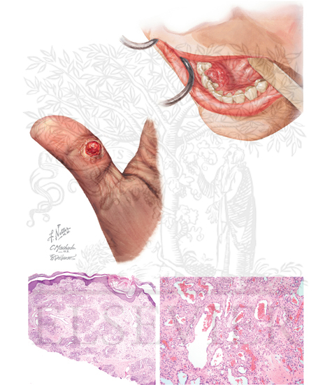 Pyogenic Granuloma