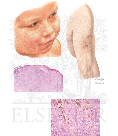 Spitz Nevus