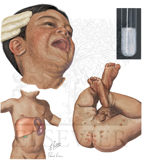 Eruptive Xanthomas: Congenital Hyperlipoproteinemia