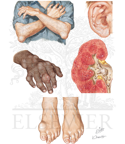 Gout: Tophaceous Gout