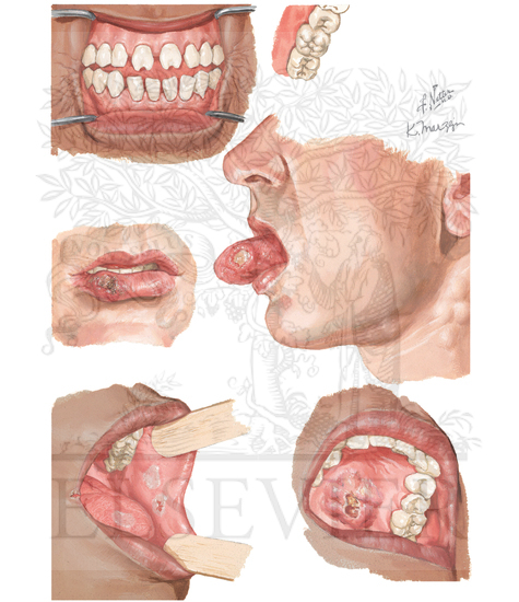 Syphilis: Oral Cavity