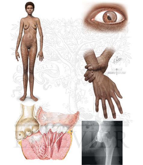 Watermarked preview of unlabeled image: Marfan Syndrome