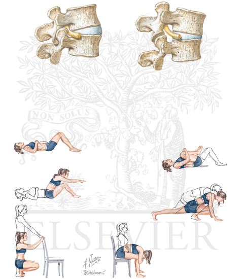 Low Back Pain and Effects of
Lumbar Hyperlordosis and
Flexion on Spinal Nerves
