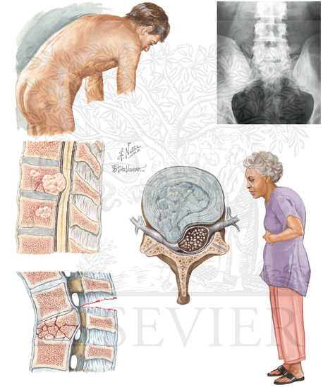 Watermarked preview of unlabeled image: Examination of the Low Back Pain Patient: OSTEOPOROSIS