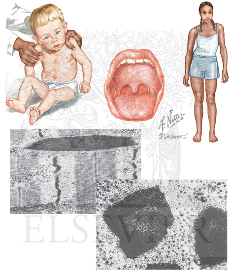 Watermarked preview of unlabeled image: Congenital Myopathies